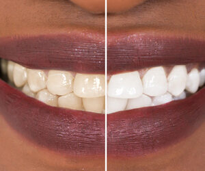 What You Should Know About a Home Teeth Whitening Kit