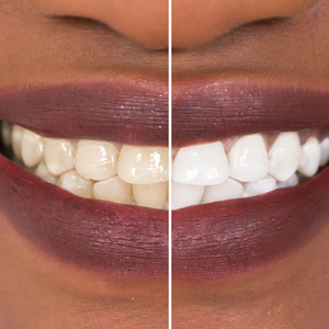 What You Should Know About a Home Teeth Whitening Kit