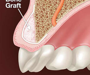 Bone Grafting Might be Necessary Before You Obtain an Implant