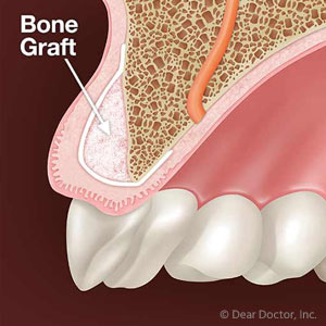 Bone Grafting Might be Necessary Before You Obtain an Implant