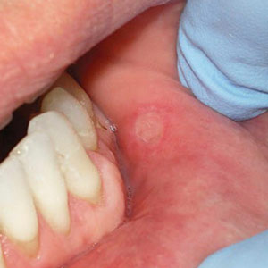 You Don’t have to Suffer from Irritating Canker Sores