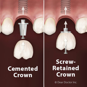 Choosing a Screw or Cement to Attach an Implant Crown