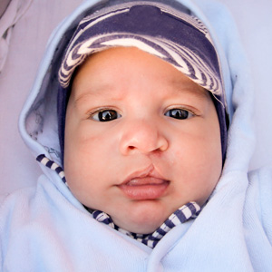 Cleft Repair can Restore a Smile, Change a Life