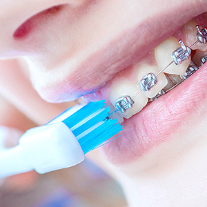 Make Efforts to Protect Your Teeth from Disease While Wearing Braces