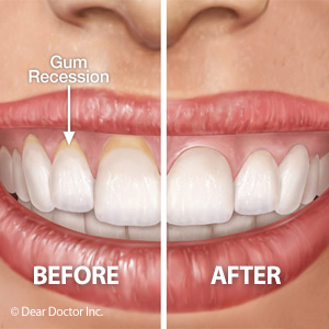 Cosmetic Gum Surgery Can Help Restore Lost Tissues Around Teeth