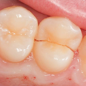 Treating Small Enamel Cracks Could Help you Avoid a Dangerous Tooth Fracture