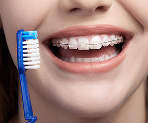 Put the Extra Effort in Your Oral Hygiene While Wearing Braces