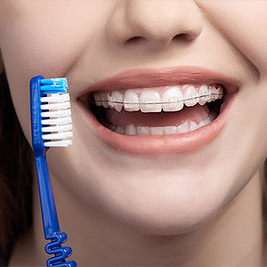 Put the Extra Effort in Your Oral Hygiene While Wearing Braces