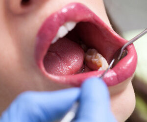 Oral Cancer Is Deadly – But You Can Lower Your Risk With a Healthy Lifestyle