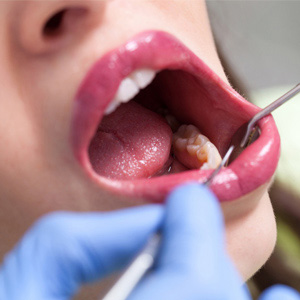 Oral Cancer Is Deadly – But You Can Lower Your Risk With a Healthy Lifestyle