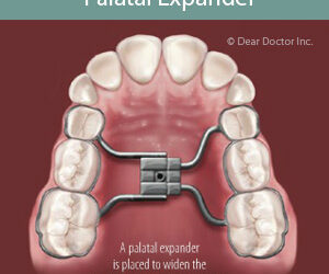 Interceptive Orthodontics: Stopping Poor Bites Before They Develop