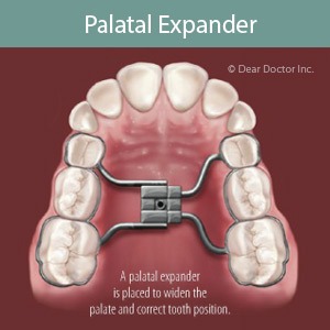 Interceptive Orthodontics: Stopping Poor Bites Before They Develop