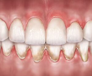 Your Gum Tissue ‘Biotype’ Could Determine How Gum Disease Affects You