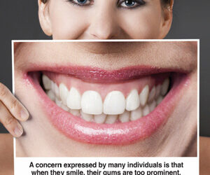 You Don’t Have to Live with a Gummy Smile. Here’s How We Can Change it!