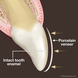 No- or Minimal-Prep Veneers Reduce Permanent Alterations to Your Teeth