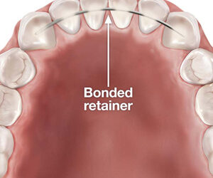 A Bonded Retainer Might Work for You after Orthodontic Treatment