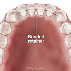 A Bonded Retainer Might Work for You after Orthodontic Treatment