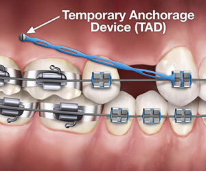 Anchorage Tools Help Orthodontists Correct Complex Bite Problems