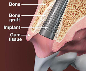 Your Gums and Bone Need to Be Healthy Before Getting Implants