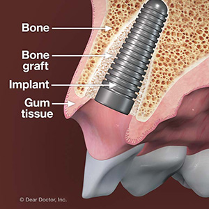 Your Gums and Bone Need to Be Healthy Before Getting Implants