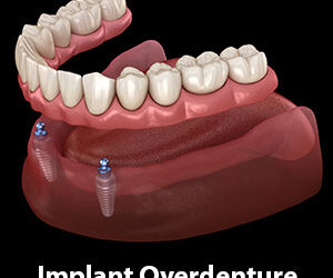 Implants Make Dentures More Secure, Comfortable and Bone-Friendly