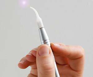 Treating Gum Disease with Lasers