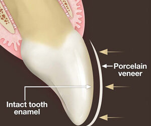 A “No-Prep” Veneer Could Eliminate the Need to Remove Tooth Enamel