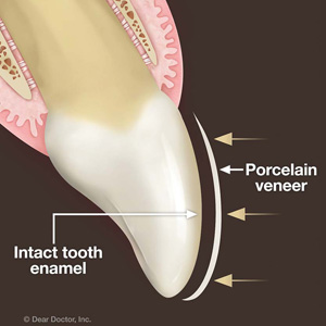 A “No-Prep” Veneer Could Eliminate the Need to Remove Tooth Enamel