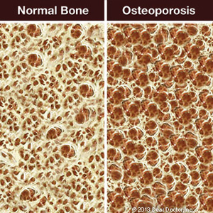 Certain Treatments for Osteoporosis Could Complicate Oral Surgery