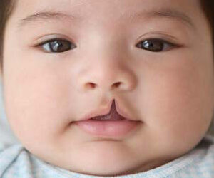 Lip or Palate Clefts can be Effectively Repaired