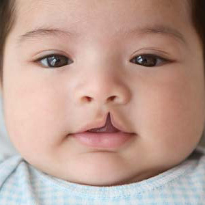 Lip or Palate Clefts can be Effectively Repaired