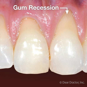 Don’t let Periodontal Disease Cause Your Gums to Recede