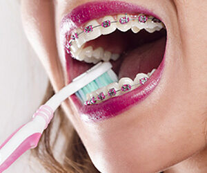 Practice Daily Hygiene to Avoid Gum Swelling While Wearing Braces