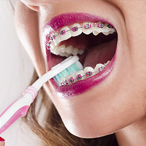 Practice Daily Hygiene to Avoid Gum Swelling While Wearing Braces