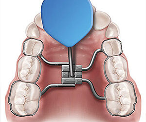 Stop Bite Problems Early With Interceptive Orthodontics