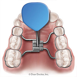 Stop Bite Problems Early With Interceptive Orthodontics