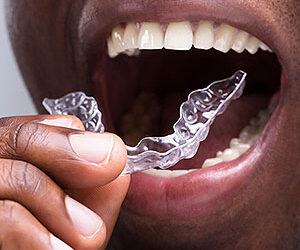 Wearing a Retainer Will Protect Your New Smile After Braces