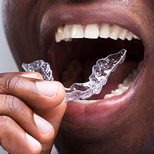 Wearing a Retainer Will Protect Your New Smile After Braces