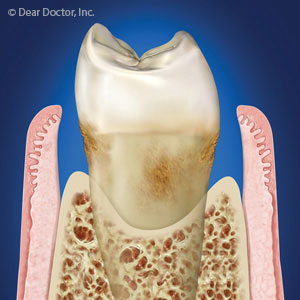 Periodontal Surgery Allows us to Access Deep Surfaces for Plaque Removal