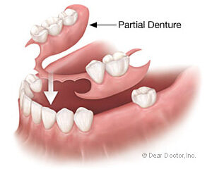 Consider an Effective and Affordable RPD for Teeth Replacement