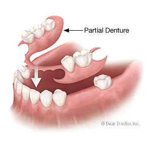 Consider an Effective and Affordable RPD for Teeth Replacement