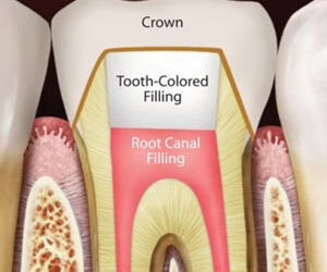 3 Reasons a Root Canal Treatment Might Fail and What You Can Do About It