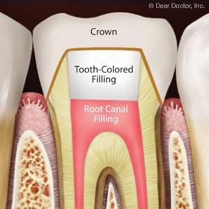 3 Reasons a Root Canal Treatment Might Fail and What You Can Do About It