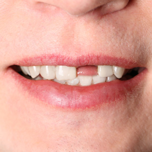 Replacing a Missing Tooth isn’t Just About Improving Your Smile