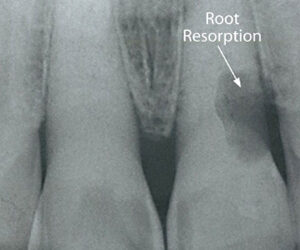 Catch Root Resorption Early for Best Chances of Saving Your Tooth