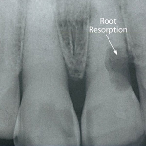 Catch Root Resorption Early for Best Chances of Saving Your Tooth