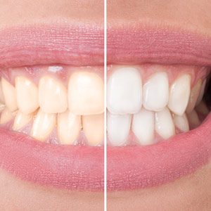 Find out What Kind of Tooth Staining you Have Before Seeking a Solution