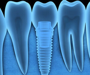 Dental Implants Better than Ever thanks to Ongoing Tech Advances