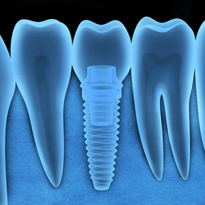 Dental Implants Better than Ever thanks to Ongoing Tech Advances