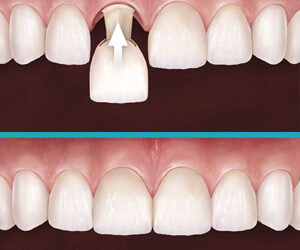 Customized Temporary Crowns Help Ensure a Satisfying Permanent Smile